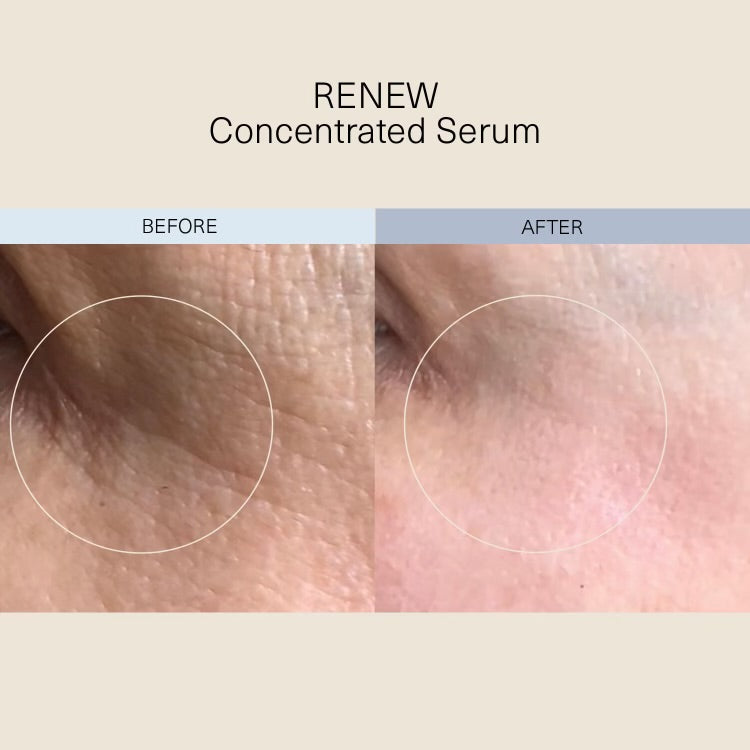 RENEW Concentrated Serum